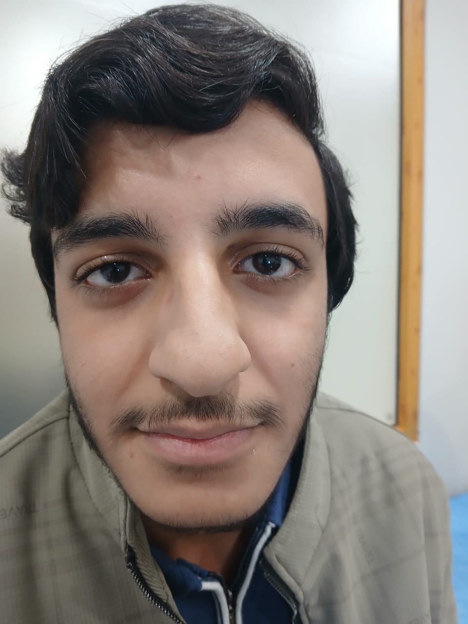 Before Ear Reconstruction